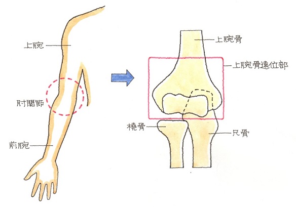 上腕骨の遠位端骨折