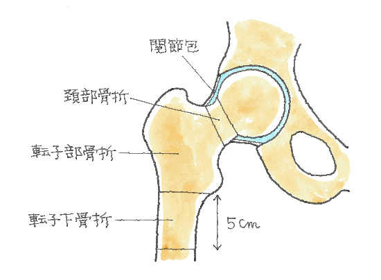 大腿骨近位部