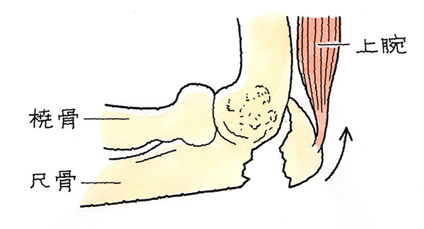 肘頭骨折