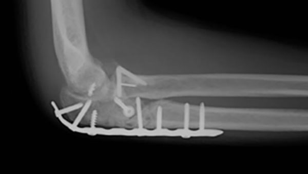 骨折した肘頭の骨の欠片が多数のとき、AOプレートで固定
