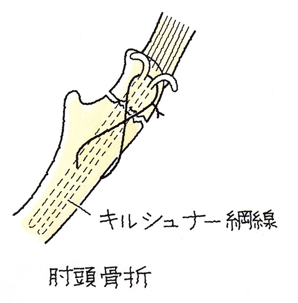 肘頭骨折Zuggurtung法（別名　tension band wiring法）