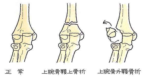 正常時、上腕骨顆上骨折、上腕骨外顆上骨折