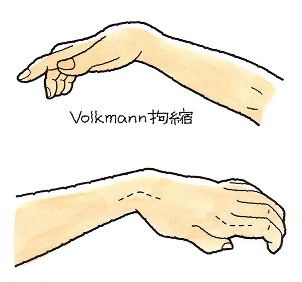 フォルクマン拘縮とは