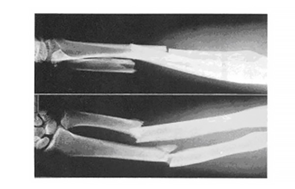 橈骨骨幹部骨折・尺骨骨幹部骨折