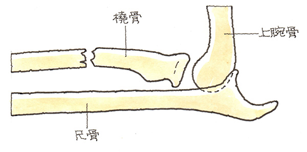ガレアッチ脱臼骨折