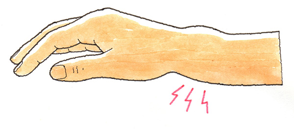 コーレス骨折が発生してフォークを伏せておいたような変形が見られる