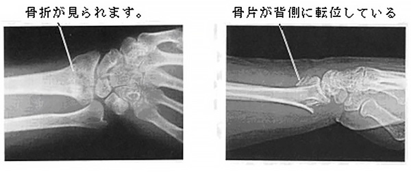 コーレス骨折のレントゲン画像（左画像は骨折が見られます。右画像は骨片が背側に転移している。）