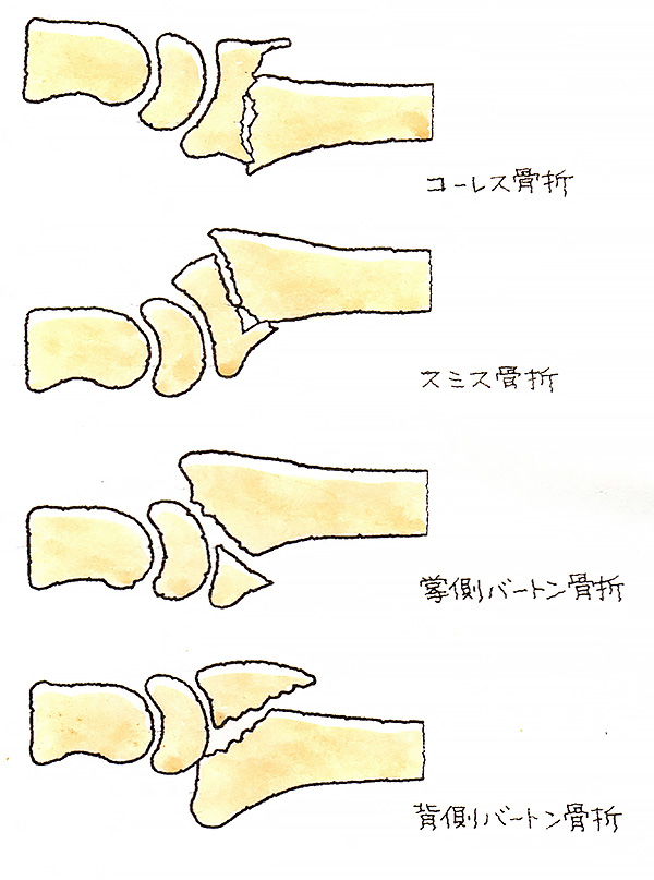 コーレス骨折、スミス骨折、掌側バートン骨折、背側バートン骨折