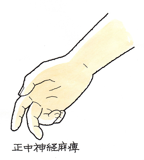 正中神経麻痺の手の様子