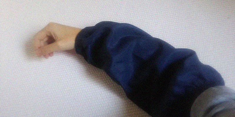 交通事故による右腕醜状痕の後遺障害を負った女性がアームカバーをつけている