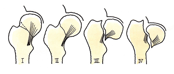 大腿骨頚部骨折4つに分類（StageⅠ～Stage　Ⅳ）
