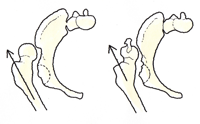 大腿骨が後方へ脱臼する股関節脱臼