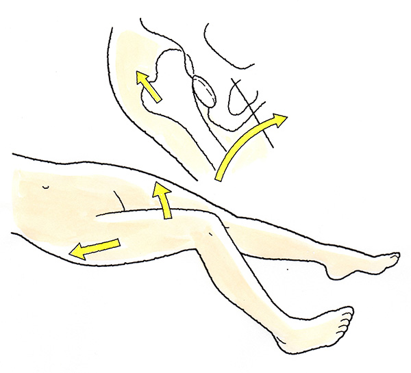骨折により骨片が遊離しているとき
