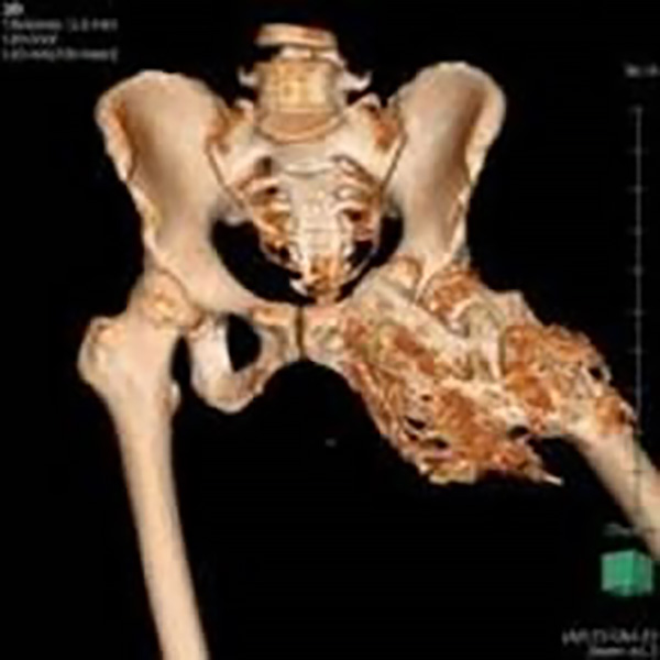 左股関節部に、重篤な外傷性骨化性筋炎が認められた画像
