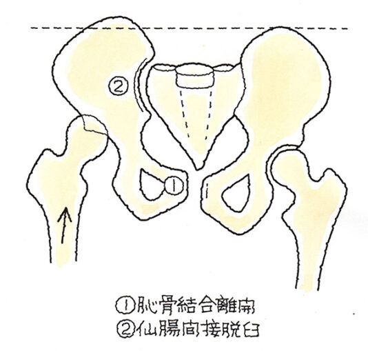 恥骨結合離開と仙腸間接脱臼