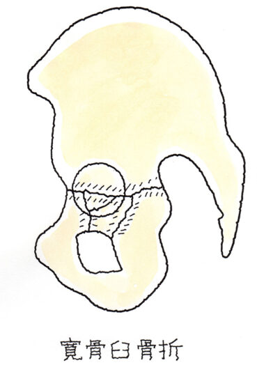 寛骨臼骨折