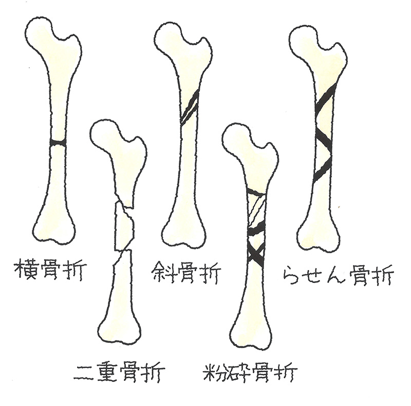 大腿骨骨幹部骨折