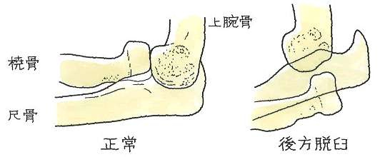 肘関節正常、後方脱臼