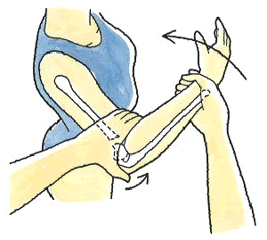 肘関節における動揺関節の後遺障害