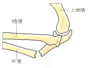 モンテジア脱臼骨折