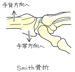 スミス骨折