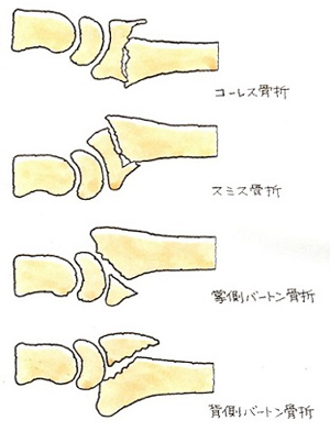 コーレス骨折、スミス骨折、掌側バートン骨折、背側バートン骨折