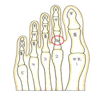 基節骨の骨折