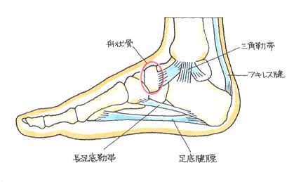 舟状骨剥離骨折