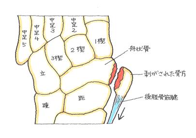 舟状骨の剥離骨折