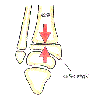 骨端線損傷‐高所から落下して足底方向から強い衝撃を受けたことにより、成長板の圧迫骨折となったもの