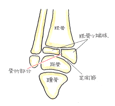 骨端線損傷-脛骨に上方から外力が作用して足関節の強い捻挫に至ったとき、脛骨骨端核が垂直方向や斜め方向に骨折したもの