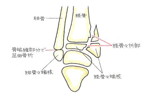 骨端線損傷-強い外力が加わった足関節捻挫で起こりやすい、脛骨骨端の内側を斜骨折し、腓骨の骨端線で屈曲骨折したもの