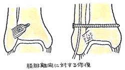 固定方法1