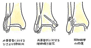 固定方法2