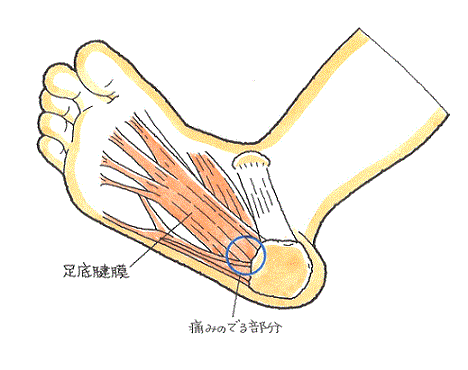 足底腱膜