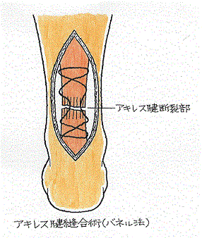 アキレス腱縫合術