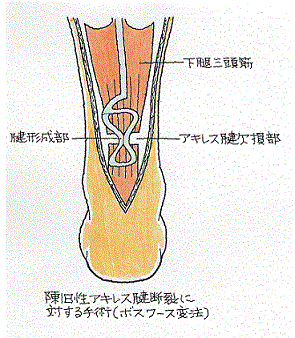 ボスワース変法