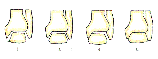 変形性足関節症-4つの段階