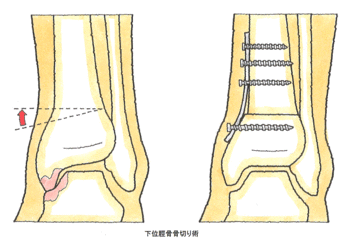 下位脛骨骨切り術