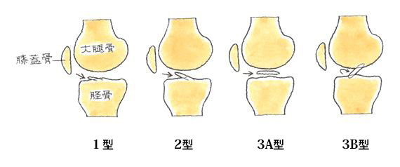 脛骨顆間隆起骨折