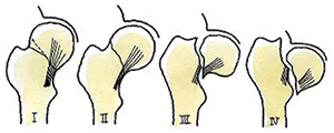 大腿骨頸部骨折-4つの分類