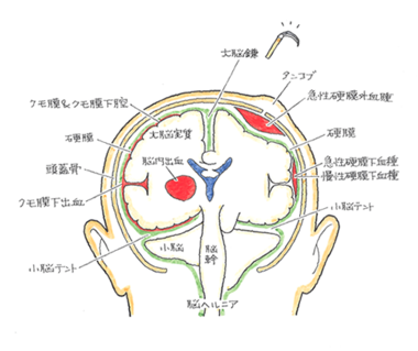 急性硬膜外血腫