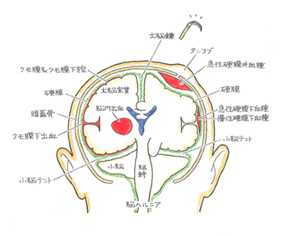 外傷性くも膜下出血