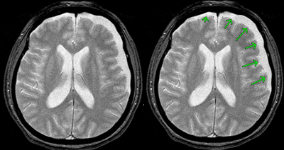 急性硬膜下血腫-MRI画像