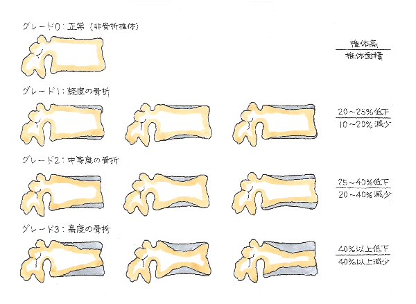 椎体骨折の評価