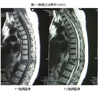 第11胸椎圧迫骨折のＭＲＩ画像