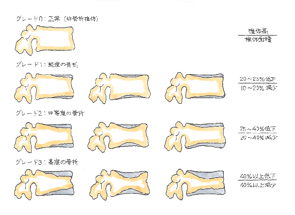 脊椎の破裂骨折