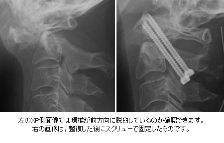 環椎の前方向脱臼とスクリュー固定