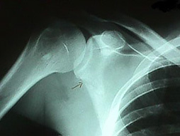 肩甲骨骨折のレントゲン1