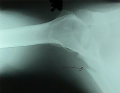 肩甲骨骨折のレントゲン2